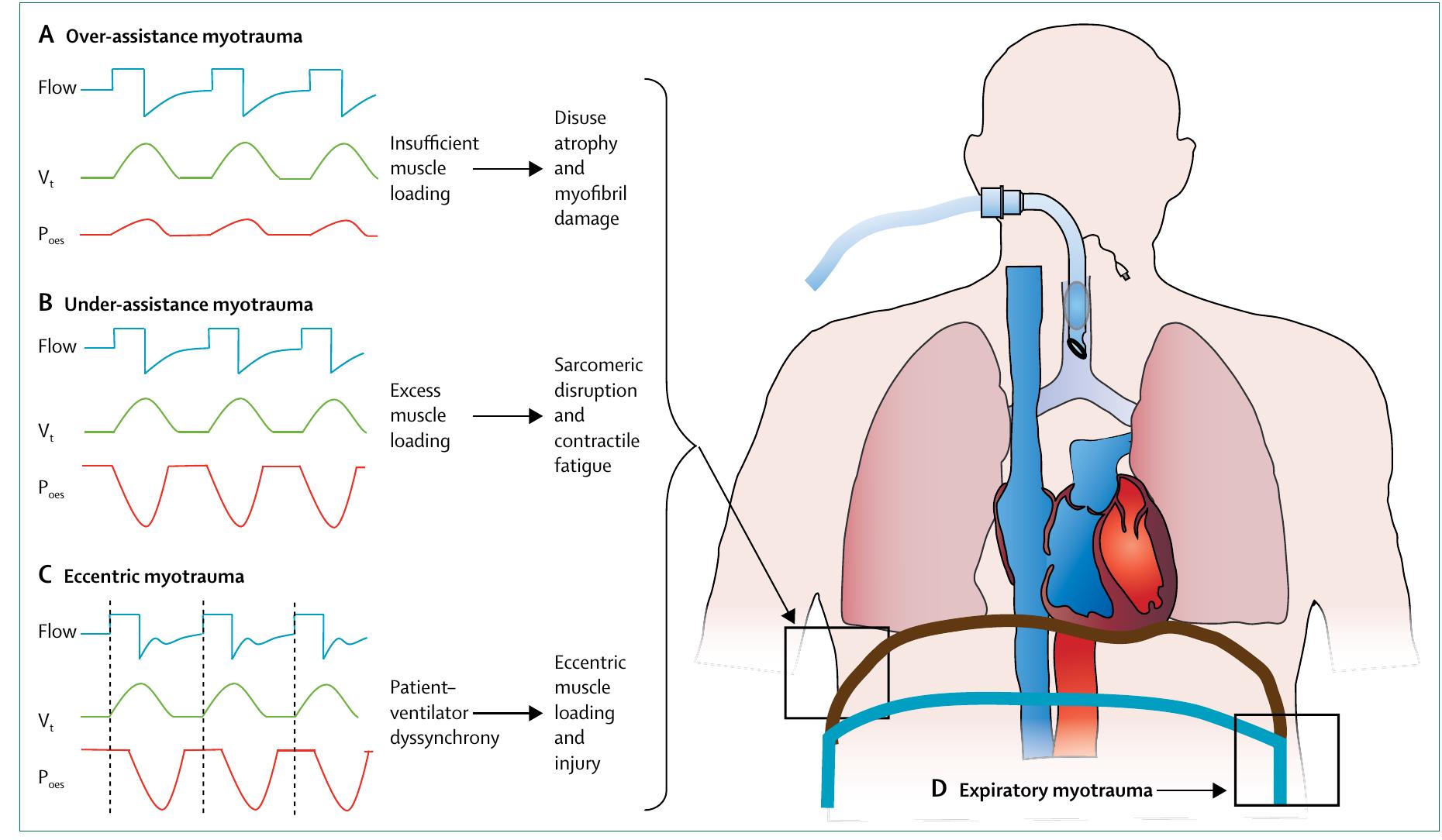 Figure 1 - from Diaphragmatic myotrauma: a mediator of