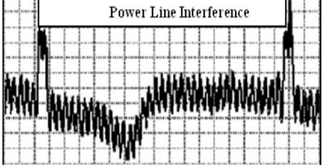 (PDF) Reduction of Power Line Interference in Ecg Signal Using Fir Filter