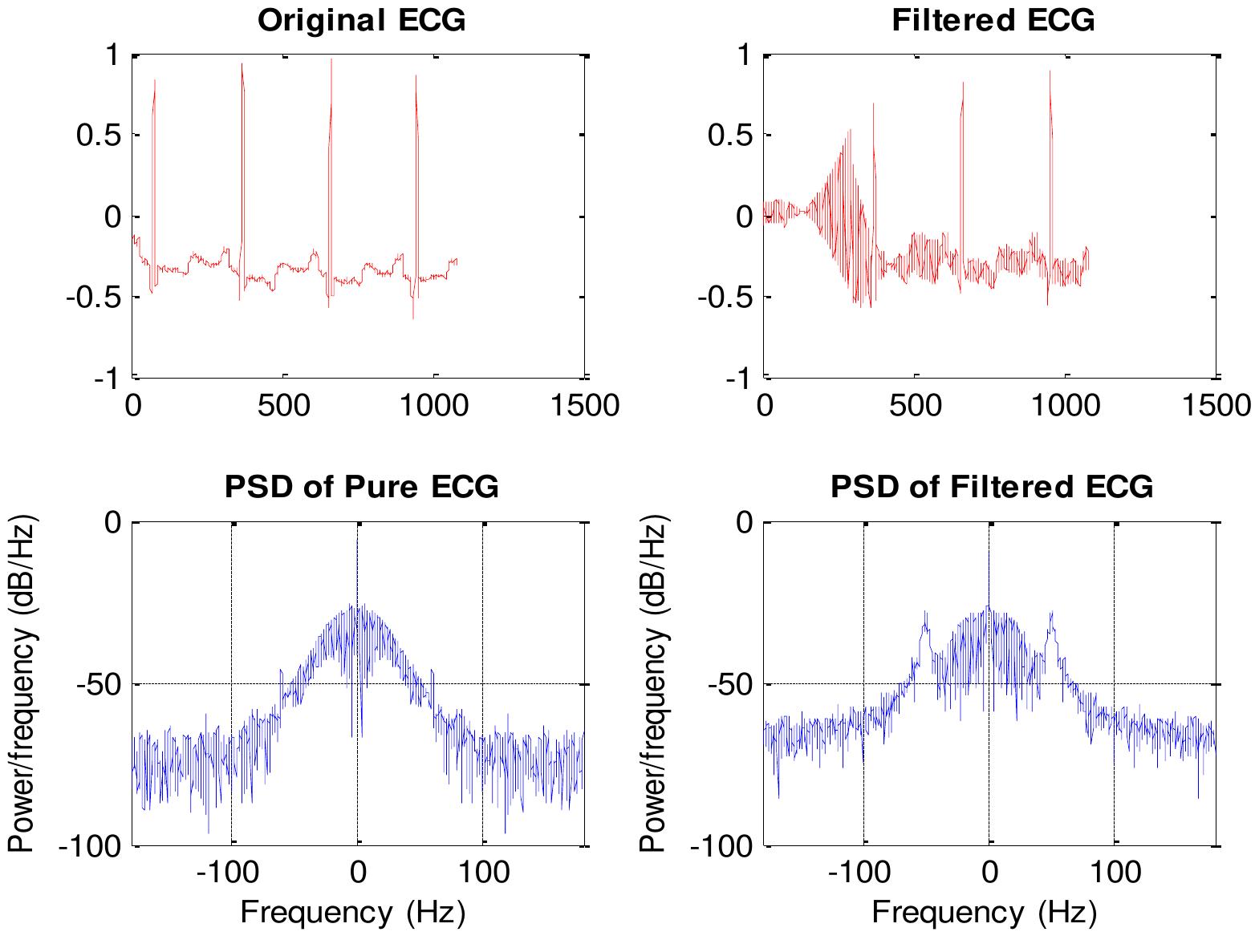 (PDF) Reduction of Power Line Interference in Ecg Signal Using Fir Filter