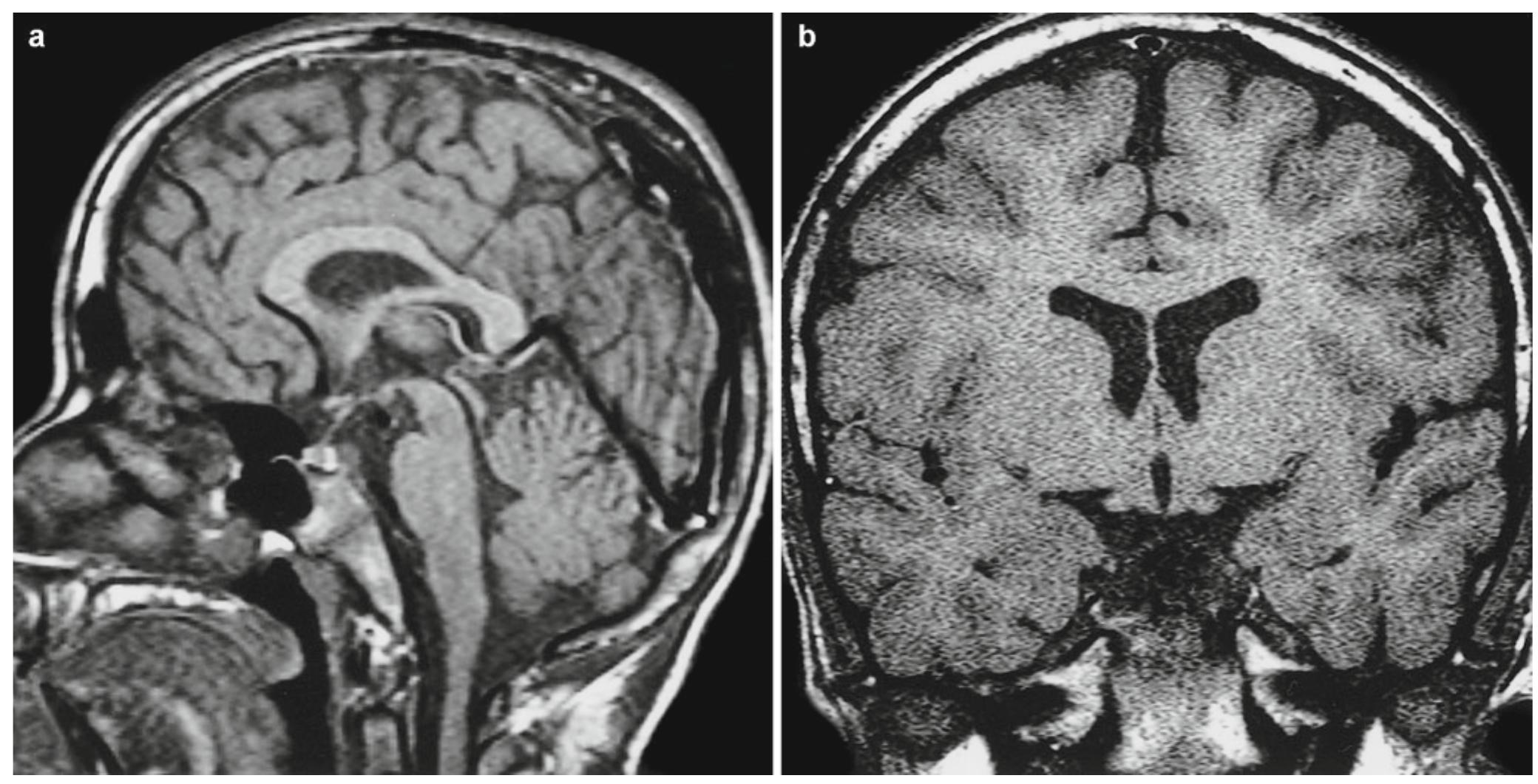 9 sagittal (a) and coronal (b) t1-weighted mri of a normal