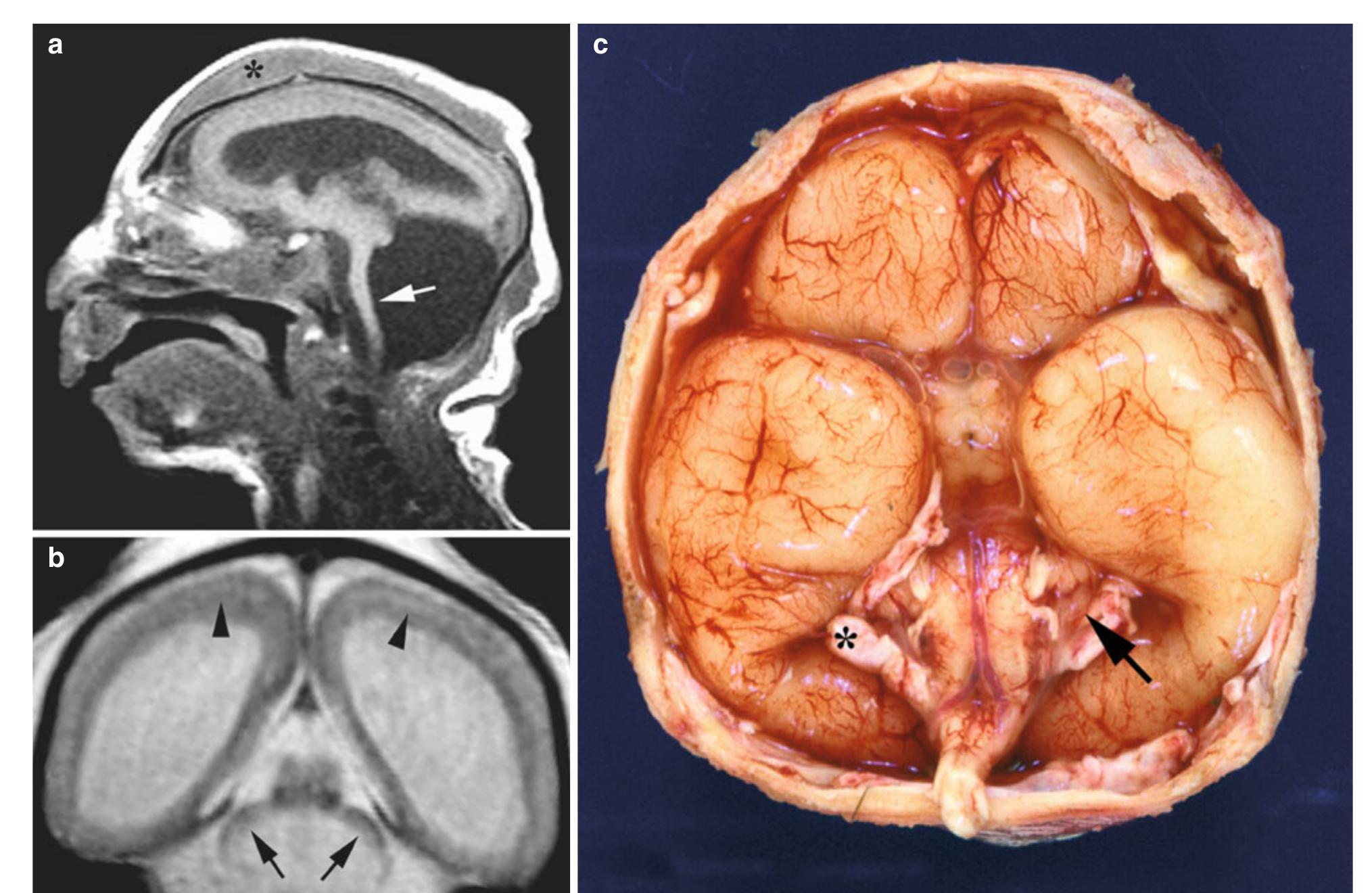 (PDF) Clinical Neuroembryology: Development and Developmental Disorders ...