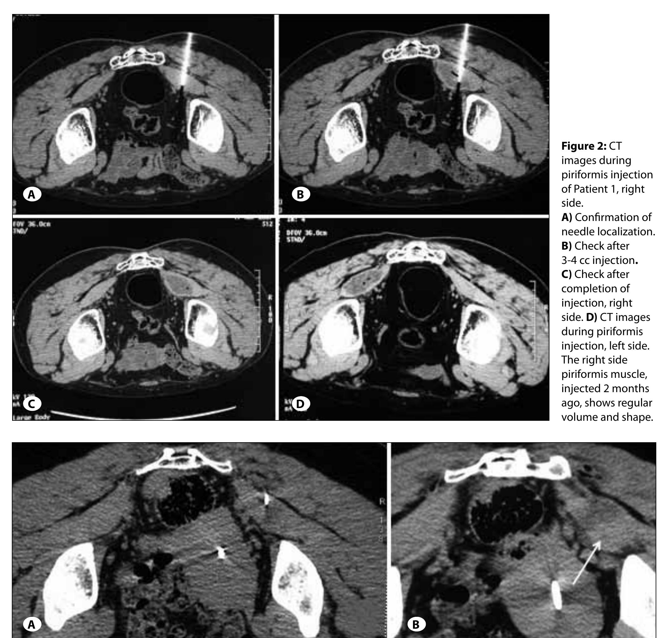 Figure 2 - from Ct-guided piriformis muscle injection for