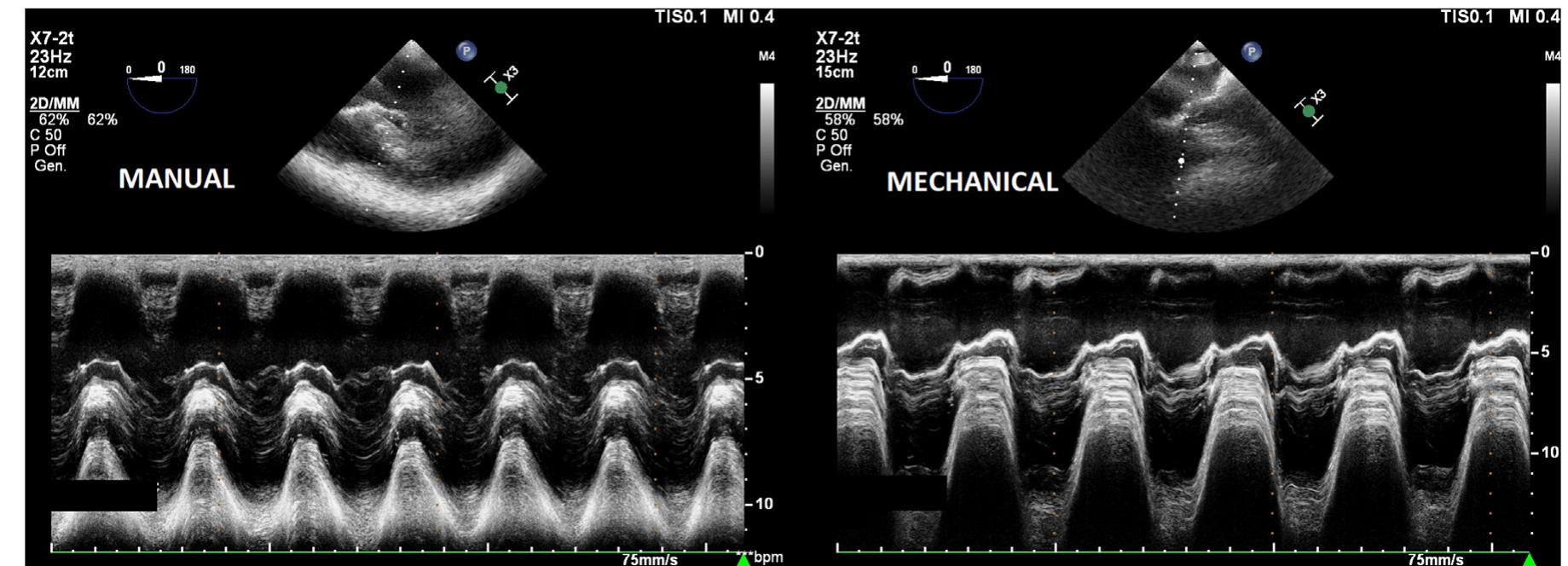 (PDF) Kinetics of manual and automated mechanical chest compressions