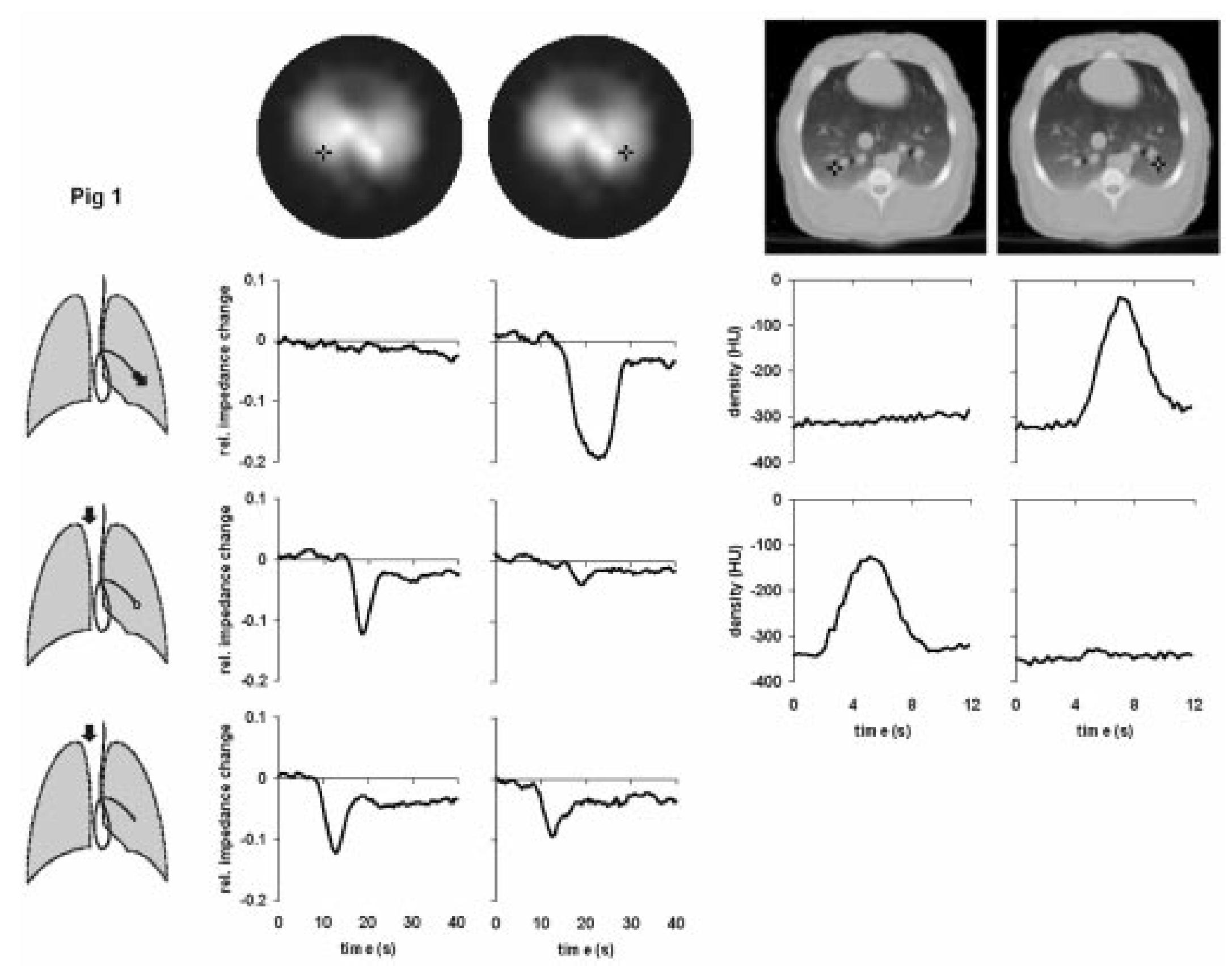 (PDF) Regional lung perfusion as determined by electrical impedance ...
