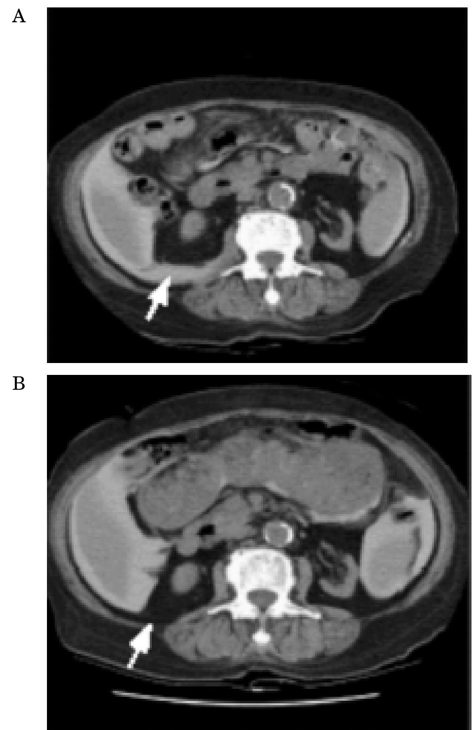 (PDF) Retroperitoneal Leakage as a Cause of Ultrafiltration Failure