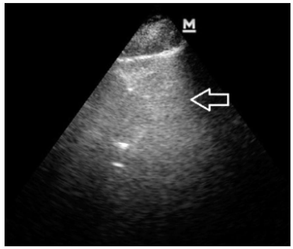 (PDF) Bedside lung ultrasonography for diagnosis of pneumonia