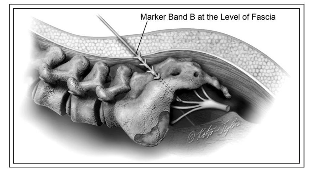 (PDF) Surgical technique for removal of tined lead for InterStim