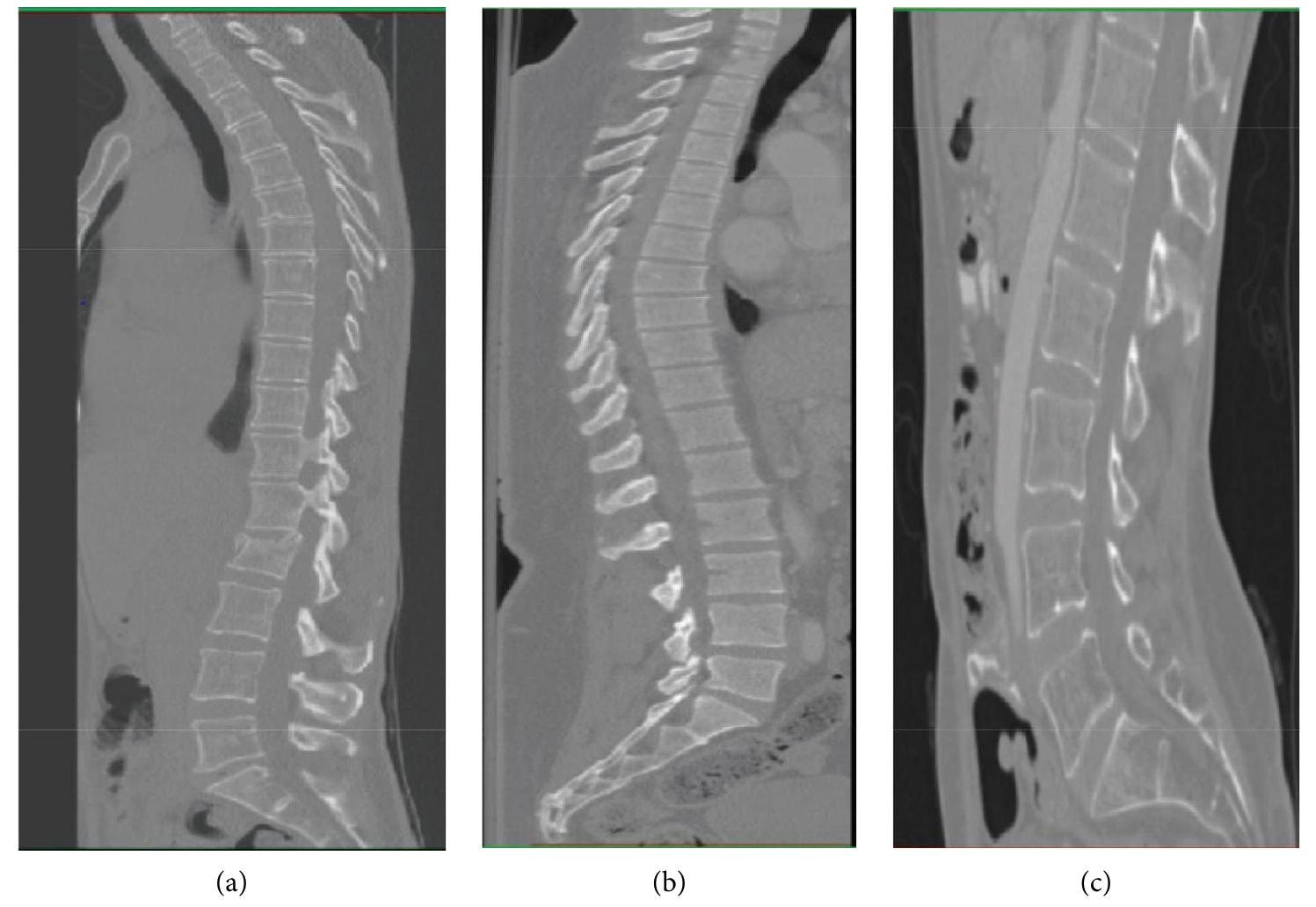 (PDF) CT-Based Automatic Spine Segmentation Using Patch-Based Deep Learning