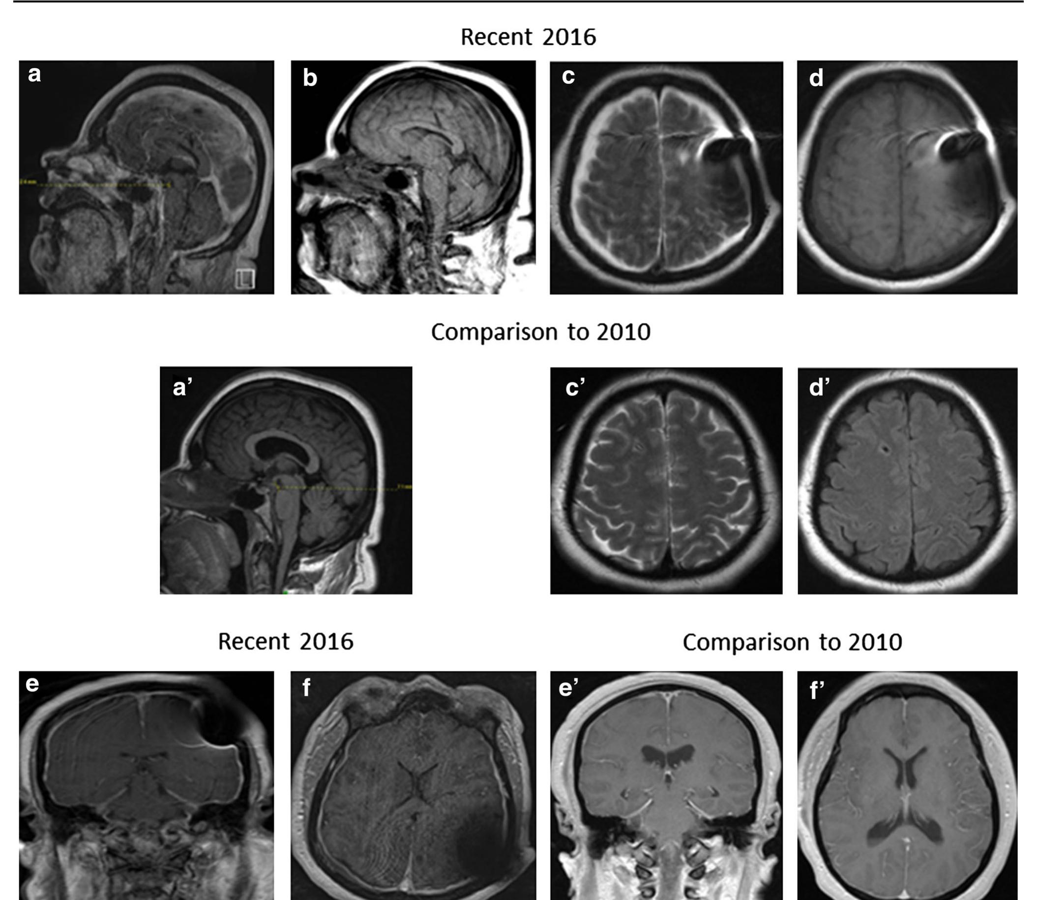 (PDF) Hyperpyrexia as the Presenting Symptom of Intracranial Hypotension