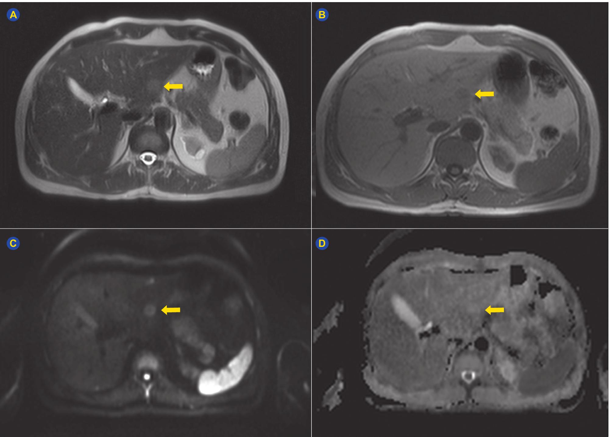 Mrn Using Wisel (PDF) Liver Multiacinar Regenerative Nodules: Imaging Findings and ...
