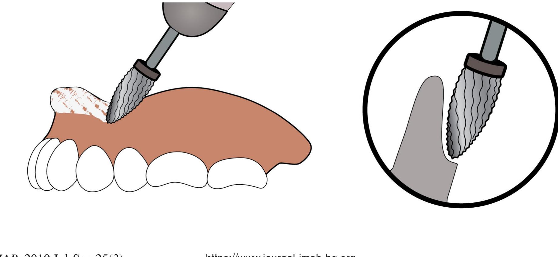 Abrading Form Abrading of the prosthetic edge and formation of an arched