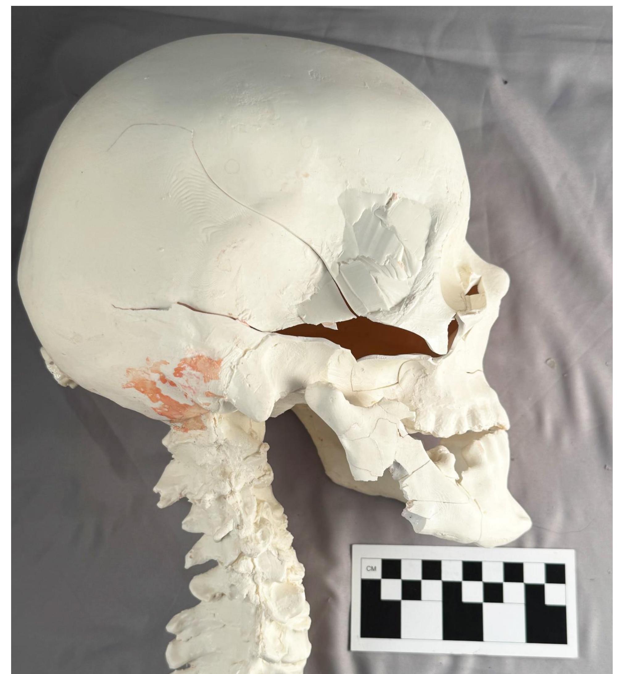 Figure 54. The reconstructed skull and lower jaw. Note the mandible’s gonial angle is missing, shattered into many small pieces by the ball as it struck the jaw. 