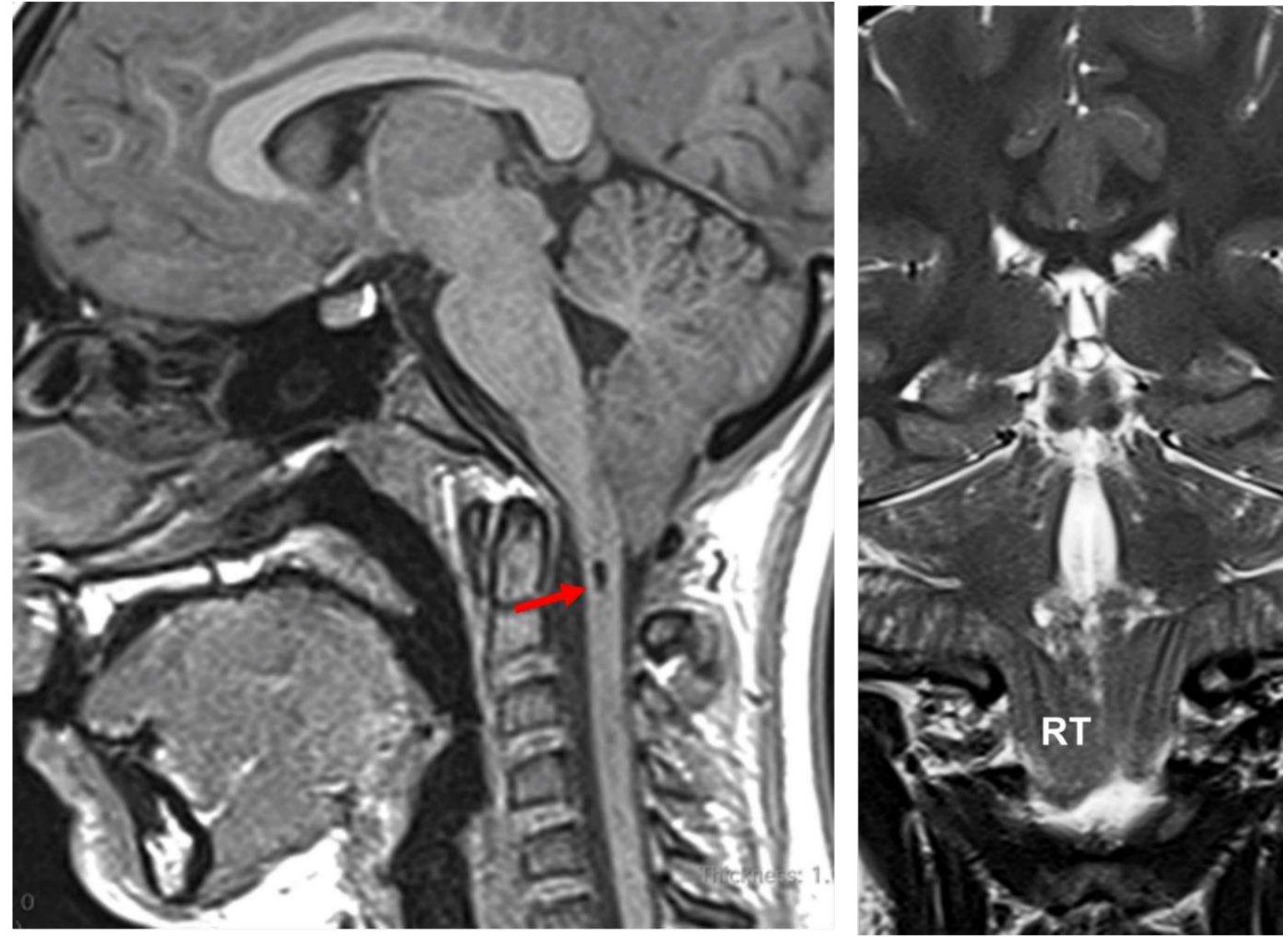 Chiari type 1 malformation. sagittal tl-weighted mri (left)