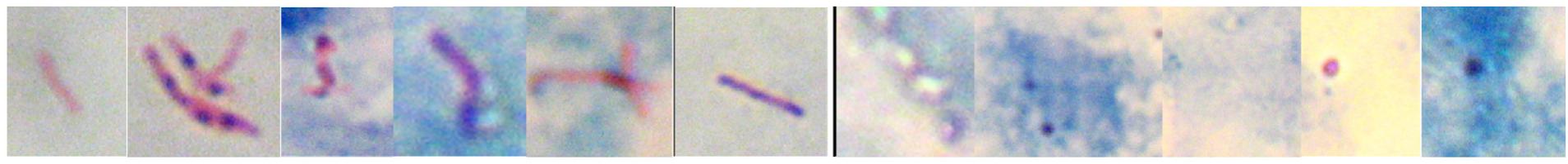 (PDF) Automatic Detection of Tuberculosis bacilli from Conventional ...