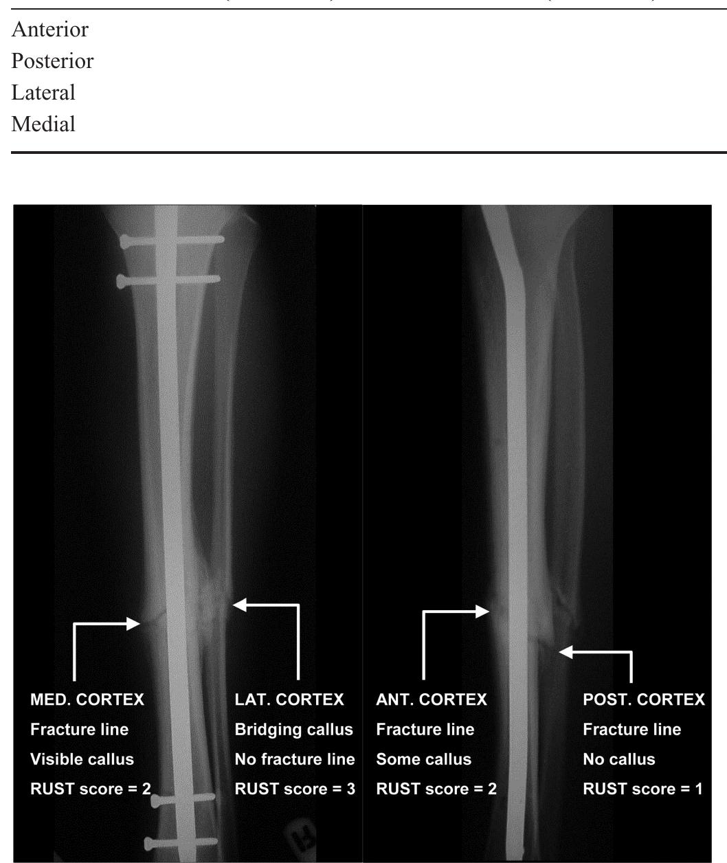Figure 1 - from Development of the Radiographic Union Score