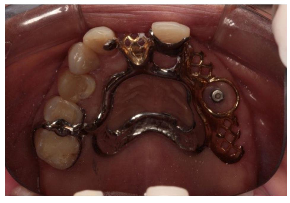 (PDF) Maxillary removable partial denture combined with O’ring ...