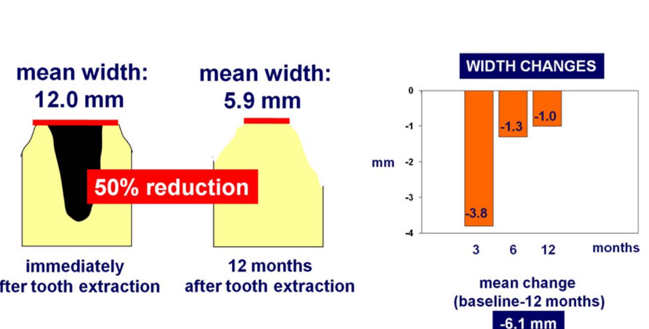 (PDF) Wound healing of extraction sockets