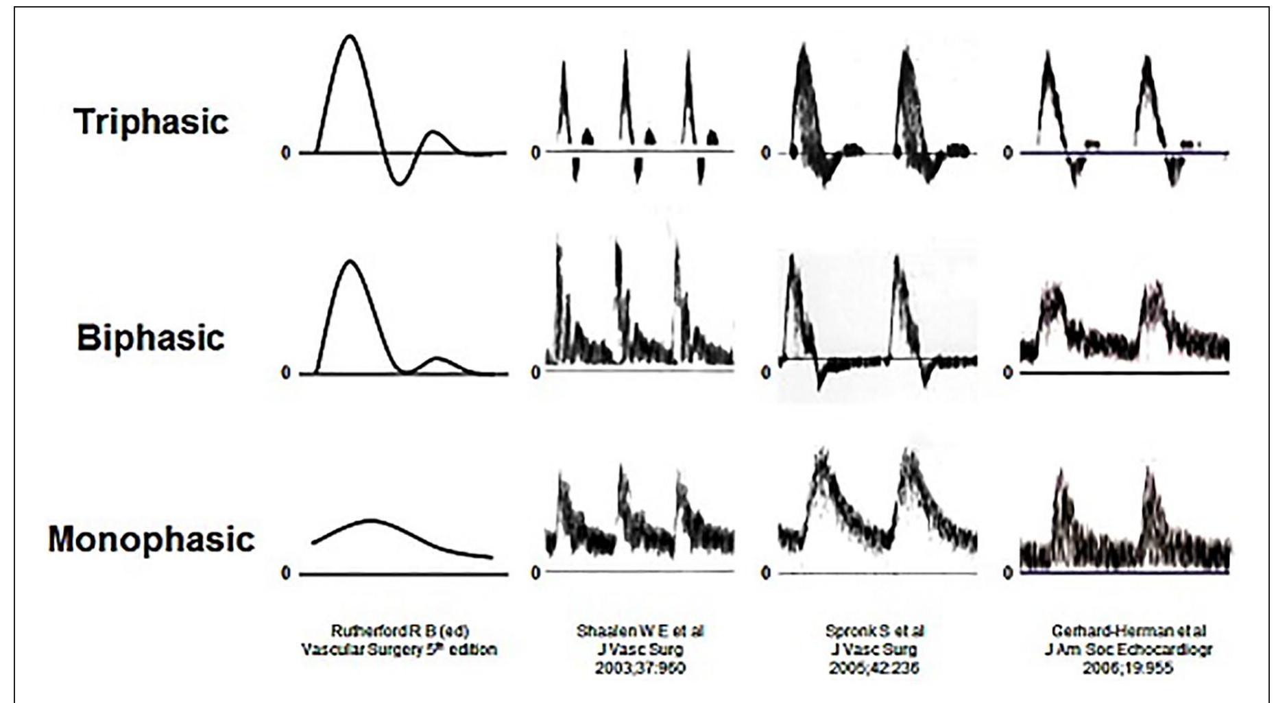 (PDF) Interpretation of peripheral arterial and venous Doppler ...
