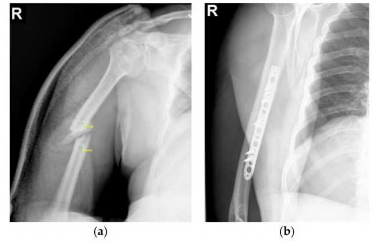 Humerus Inmotion (PDF) Failure Analysis of a Humeral Shaft Locking Compression Plate ...