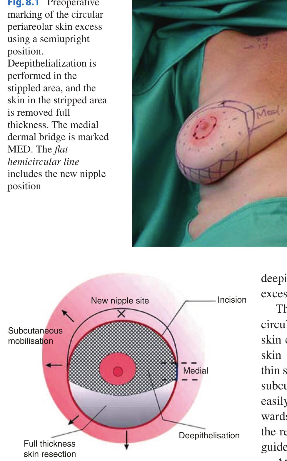 (PDF) Vertical Scar Mammaplasty with the Inferocentral Pedicle