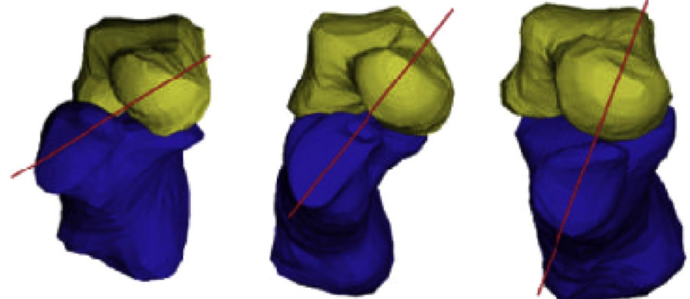 Varus Foot Rotation (PDF) Anatomy of the Varus Foot and Ankle