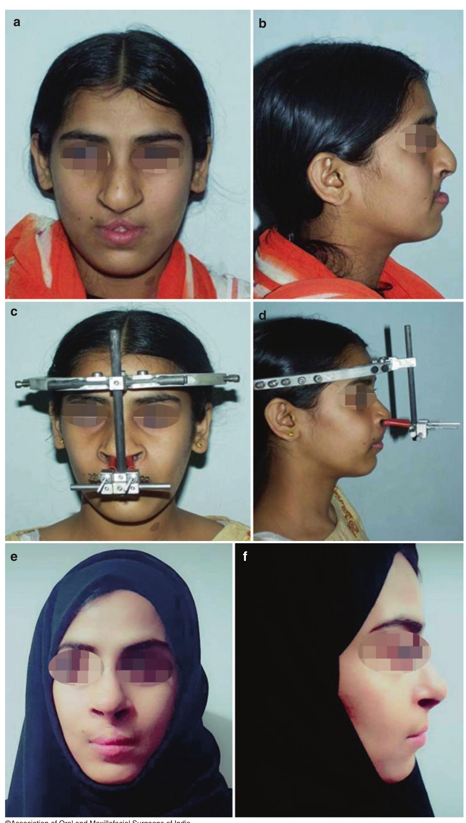 (PDF) Cleft Maxillary Hypoplasia