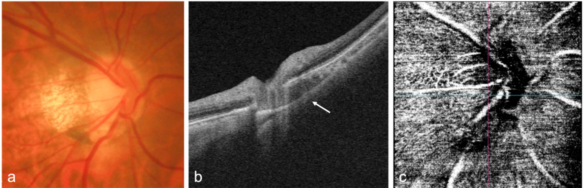(PDF) Advances in OCT Imaging in Myopia and Pathologic Myopia