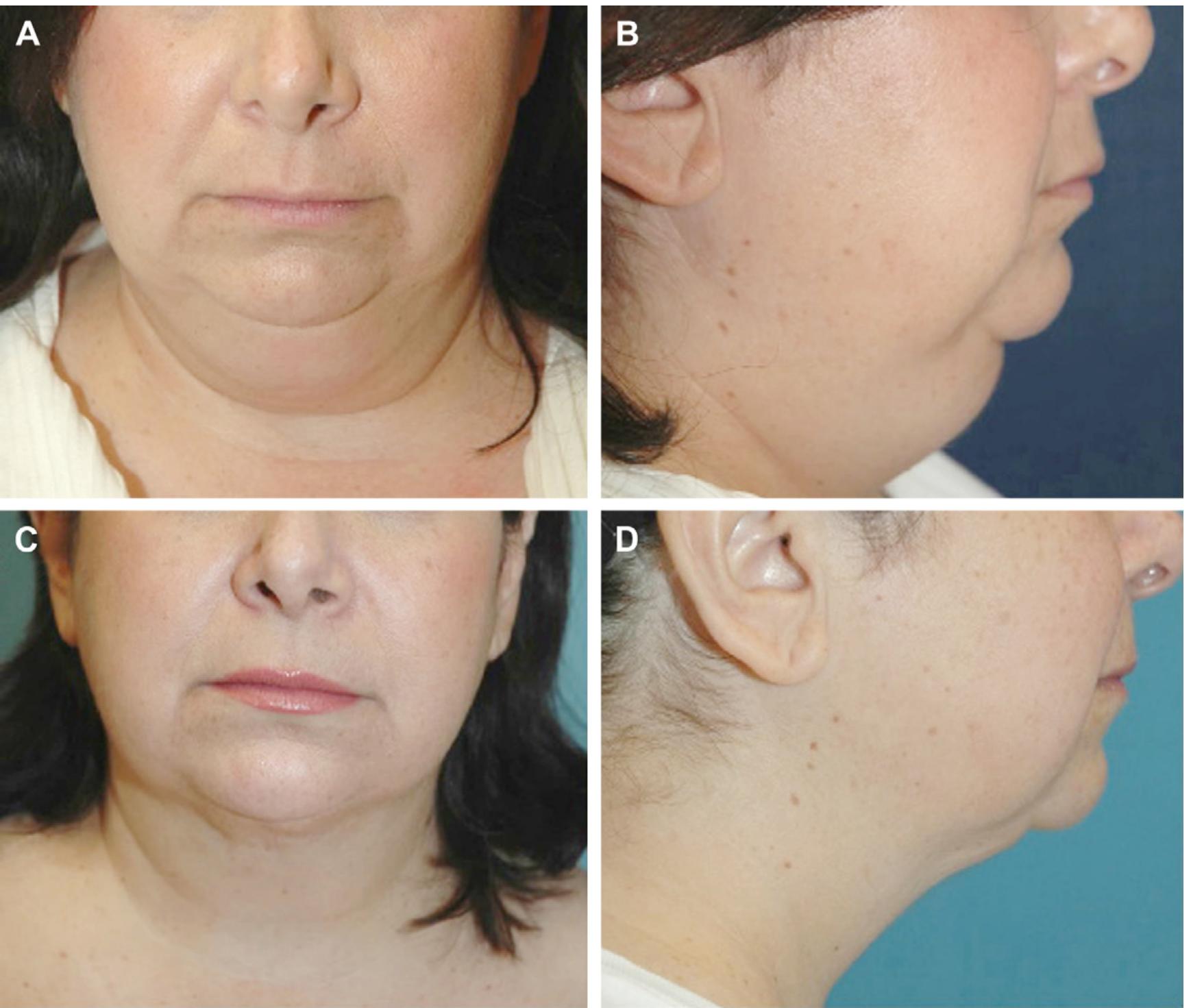Fig. 6. A 53-year-old woman who was dissatisfied with the fullness of her neck. She was treated with LAL. (A, B) Preoperative views. (C, D) Appearance 4 months postprocedure. 