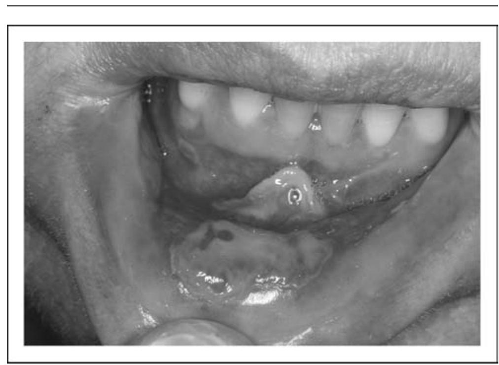 Figure 1 - from Mucositis: biology and management