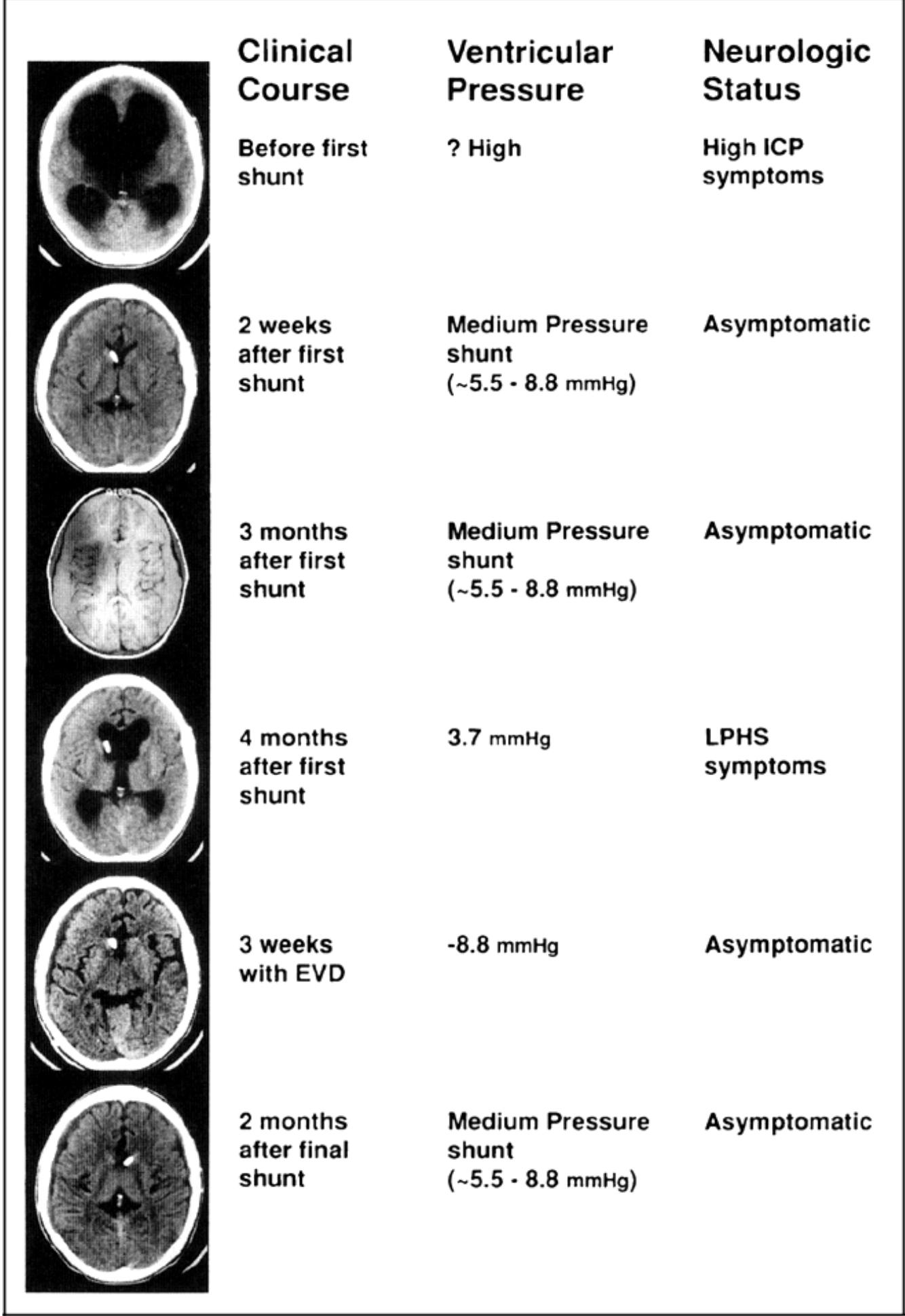 (PDF) Low-Pressure Hydrocephalic State and Viscoelastic Alterations in ...