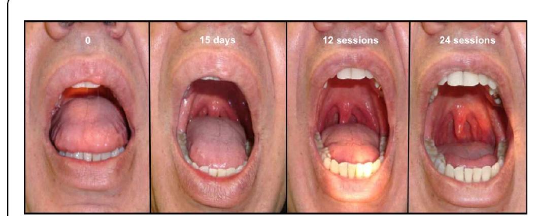 (PDF) Multidisciplinary Approach to the Patient with Obstructive Sleep ...