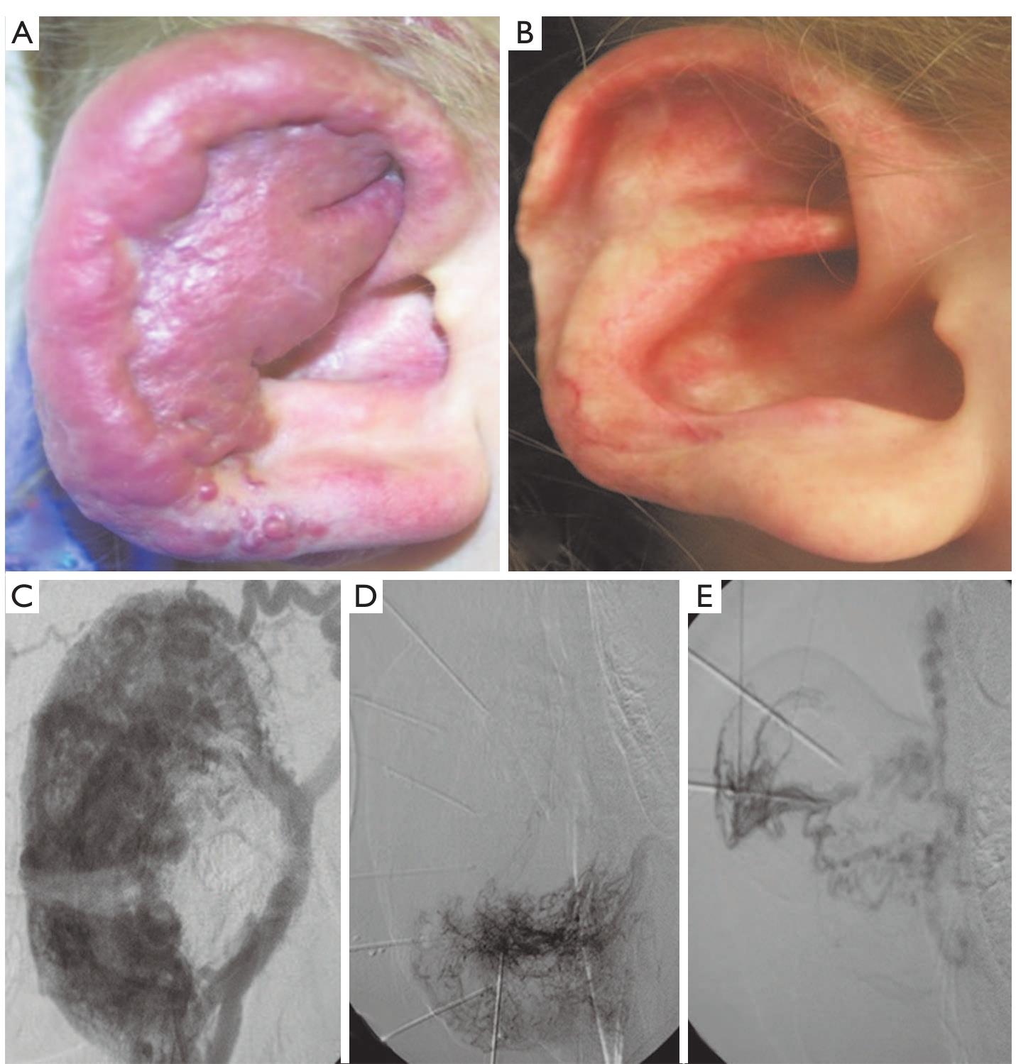 Figure 17 - from Soft-Tissue Venous Malformations in Adult