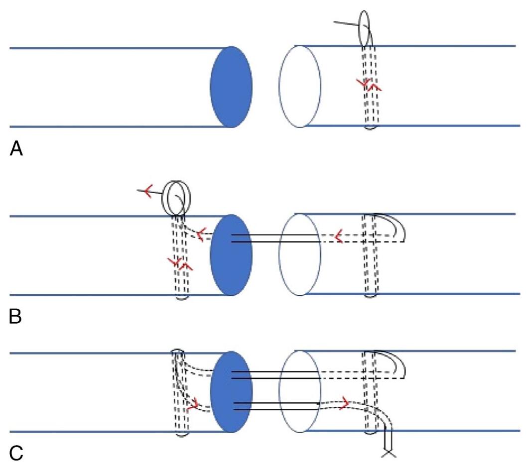 Looped Suture Use (PDF) Biomechanical Comparison of a New Loop Suture Technique With ...