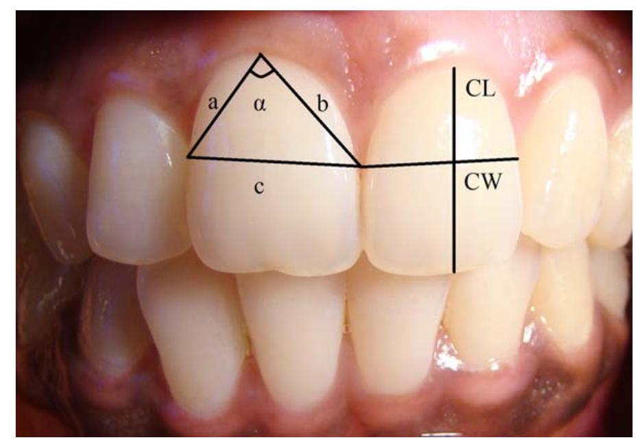 Figure 2 - from Clinical assessment of interdental papilla