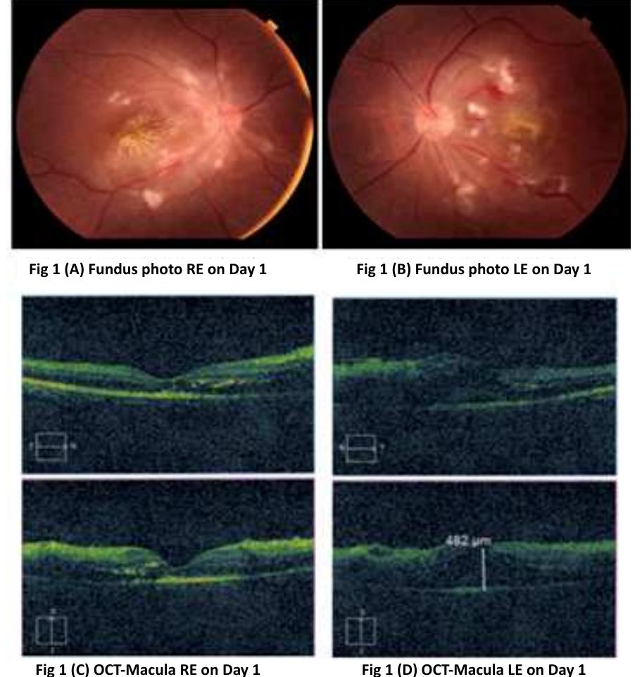 Figure 1 - from Bilateral Post-typhoid Retinitis: A Case