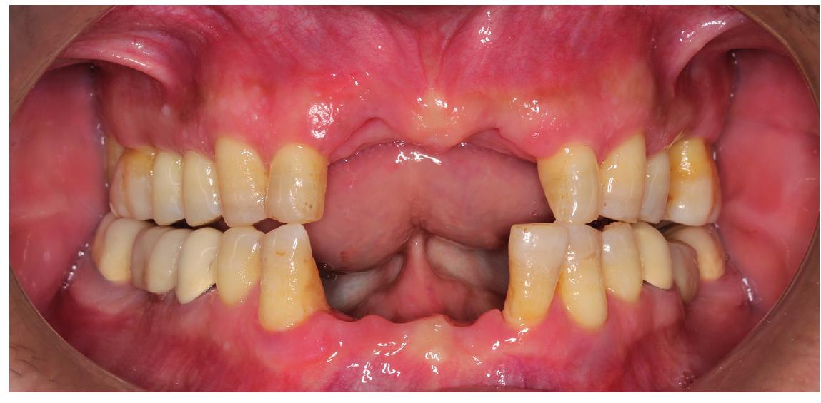 Figure 1 - from Alveolar Ridge Augmentation Techniques in