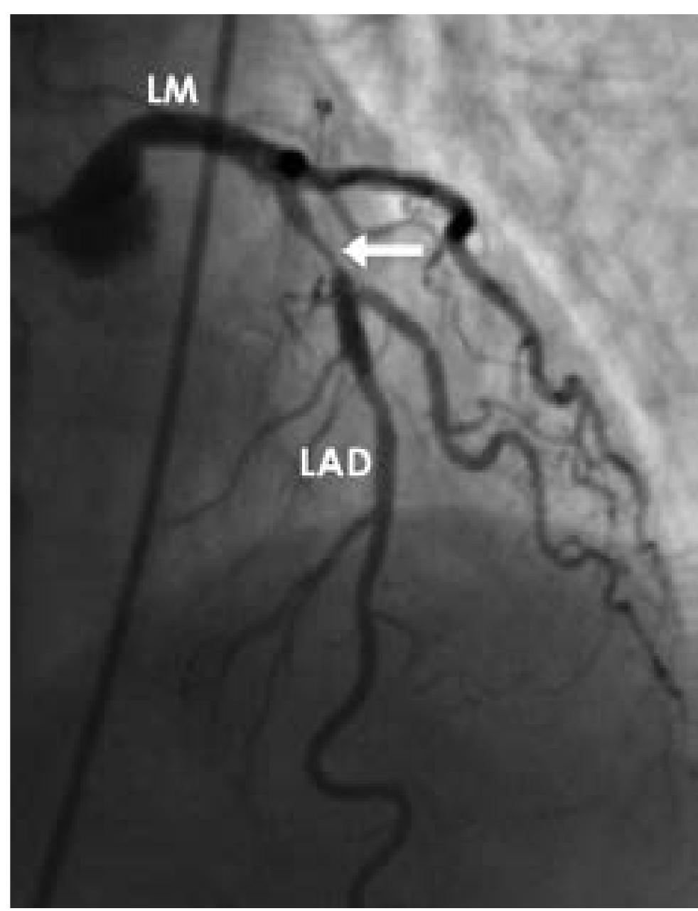 - left coronary artery angiogram. in this coronary angiogram