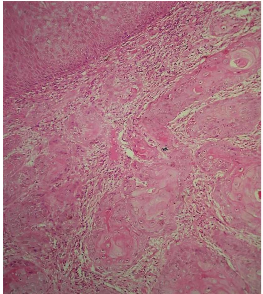 Indurayed Borders Figure 2 - from Oral erythroplakia – A case report