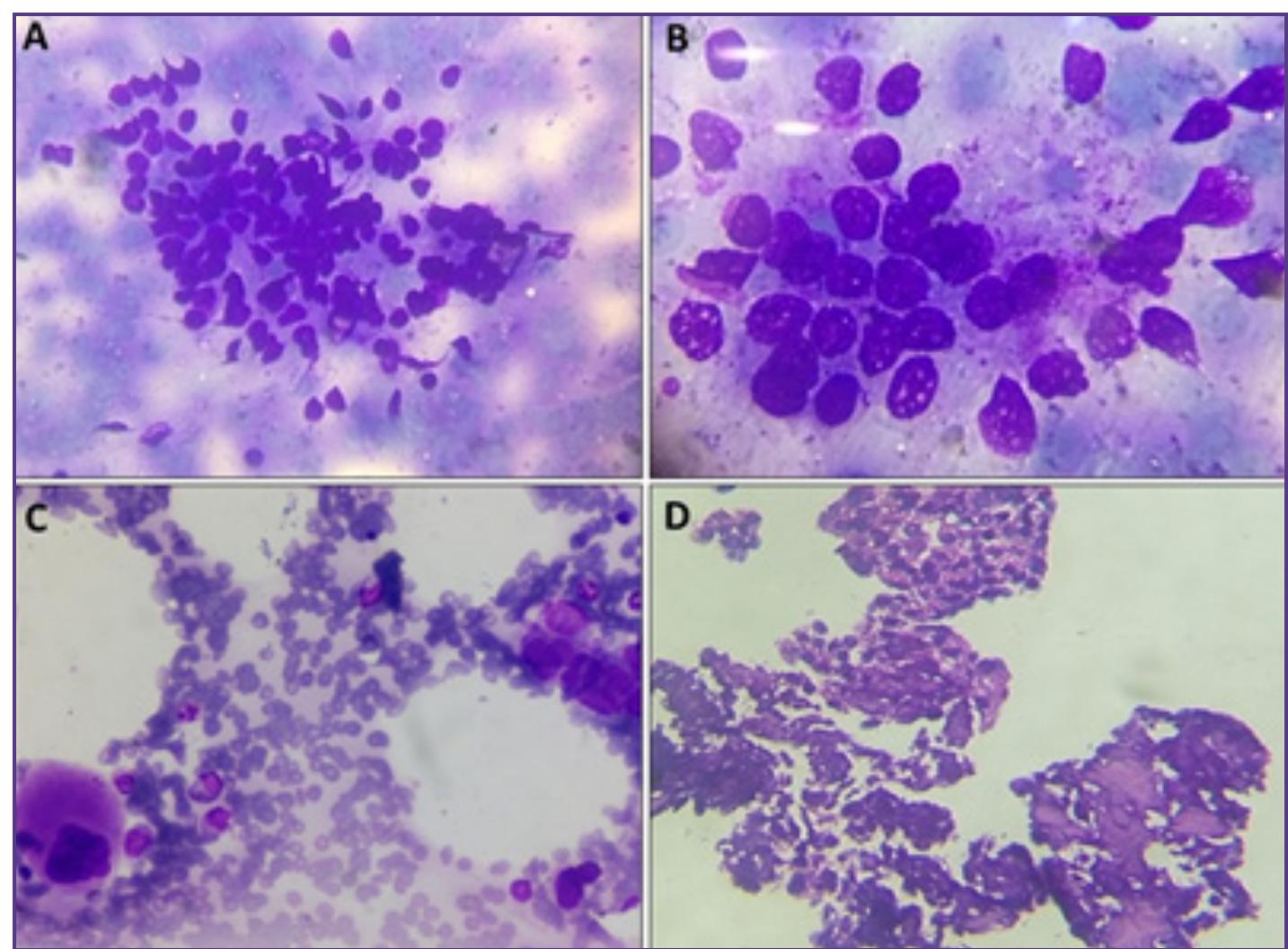 (PDF) Bone Marrow Cytomorphology And Clinico-Hematological Profile of ...