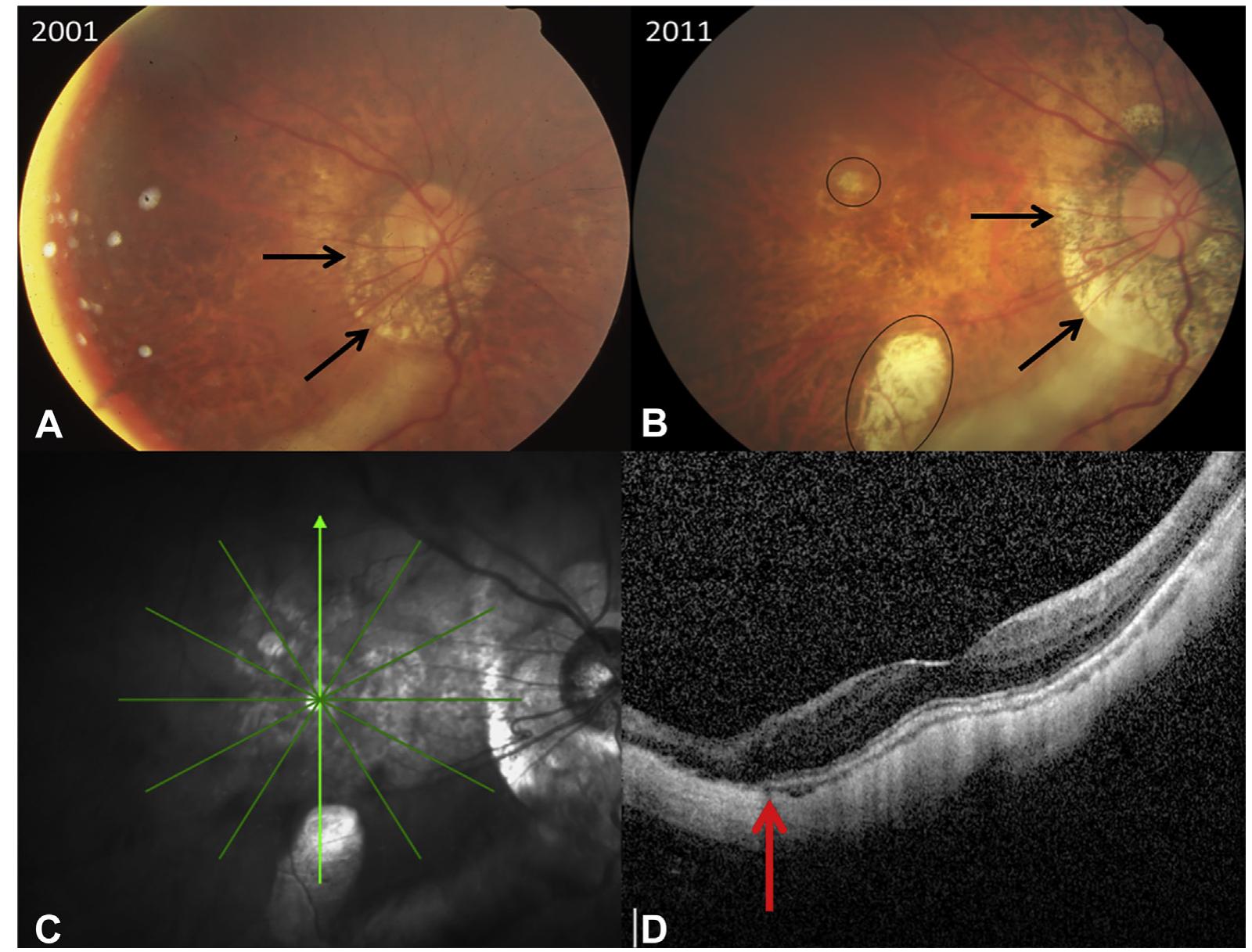 Fundus photographs showing the progression of myopic