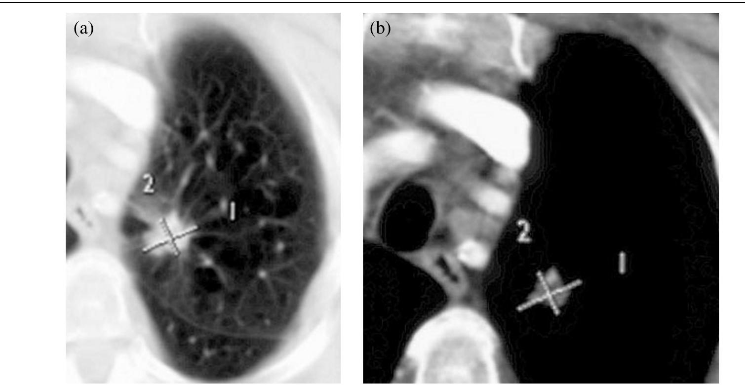 Lymph nodes in the aortopulmonary window clearly show