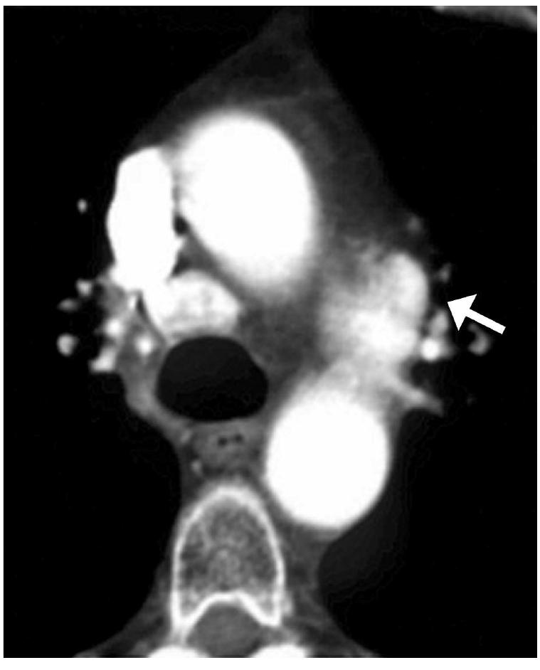 Lymph nodes in the aortopulmonary window clearly show