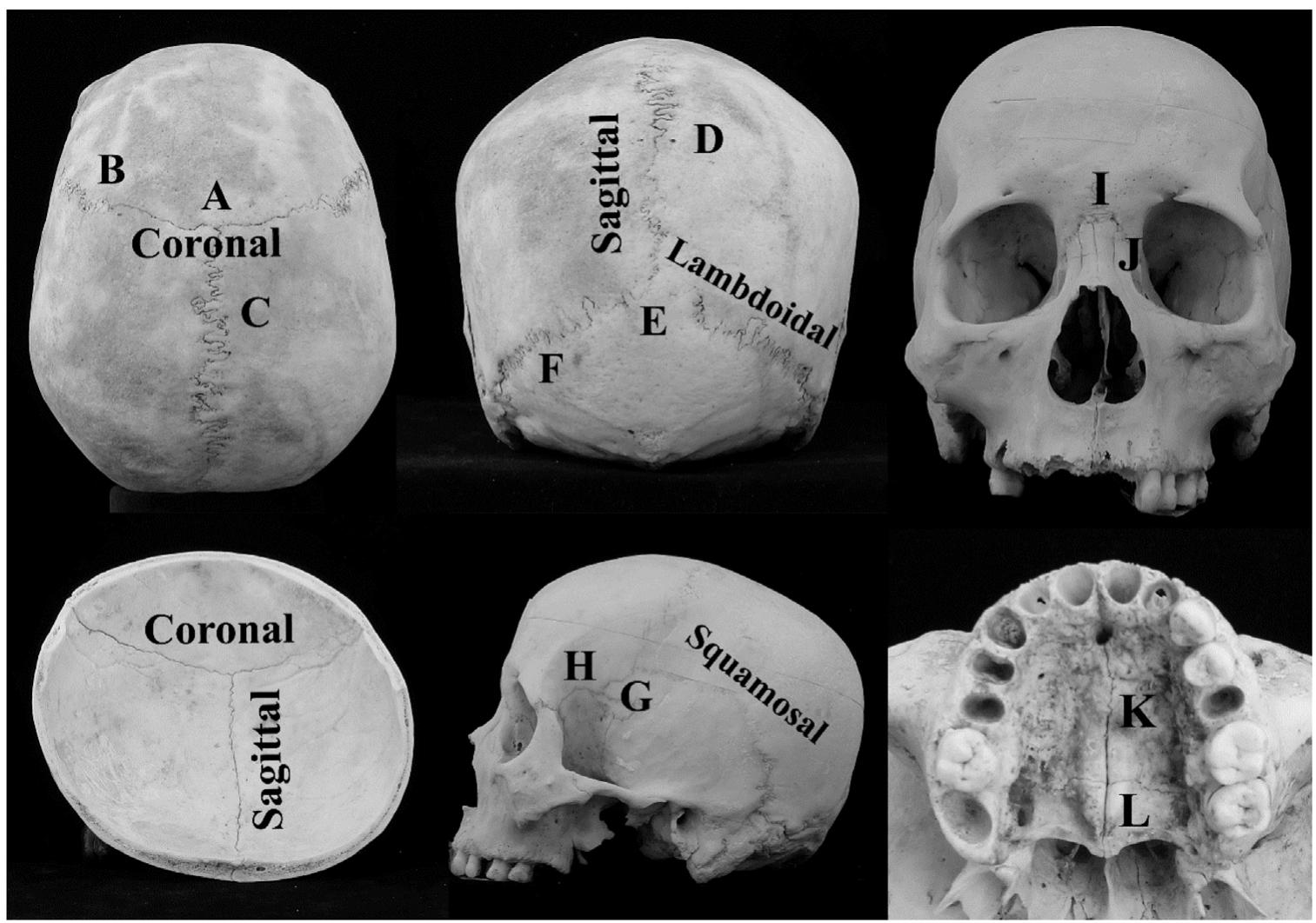 Midcornal (PDF) Cranial suture closure as an age indicator: A review