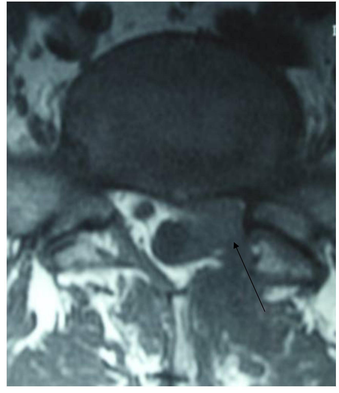 (PDF) A Review of the Degenerative Intervertebral Disc Disease