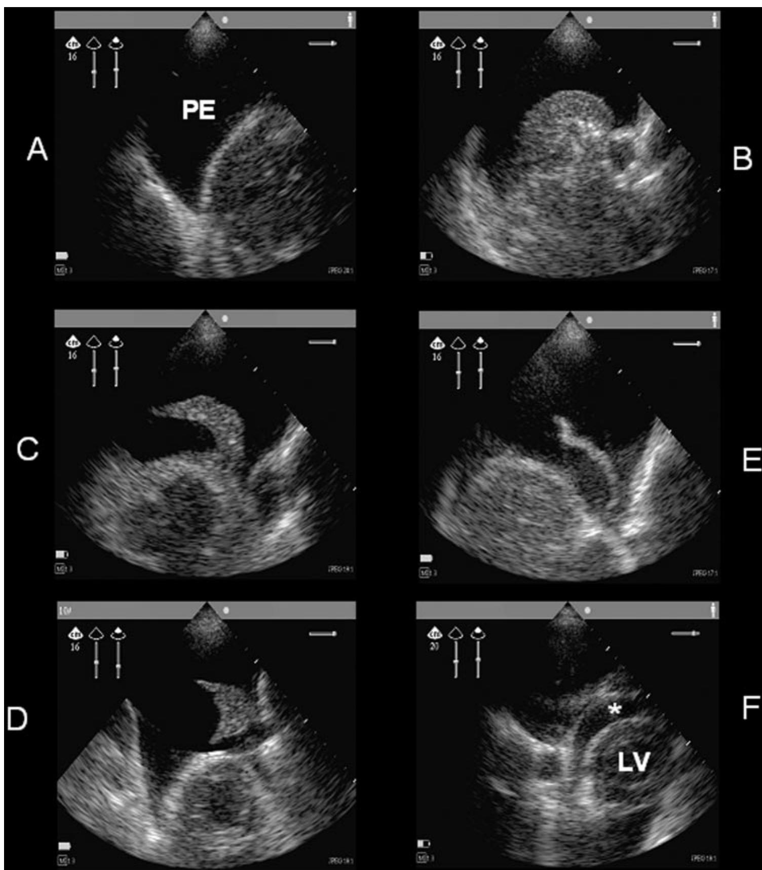 Examples of pe on the chest ultrasound. anechoic space