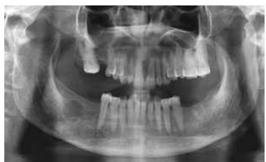 Panoramic radiograph showing well defined radiolucency