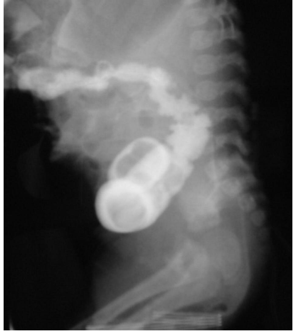 (PDF) Rectal and sigmoid atresia: transanal approach