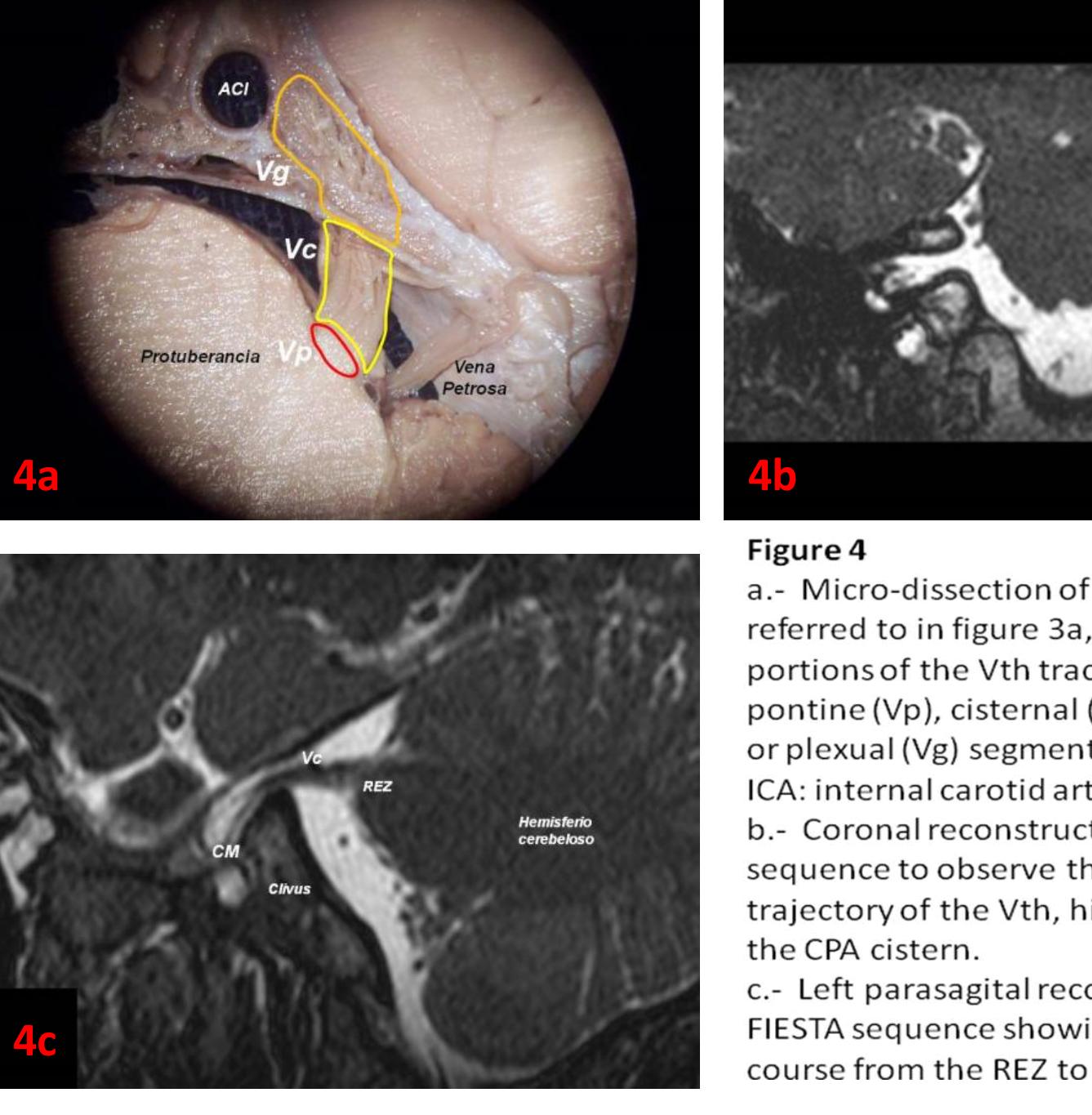 (PDF) Anatomy of the Trigeminal Nerve. Key Anatomical Facts for MRI ...