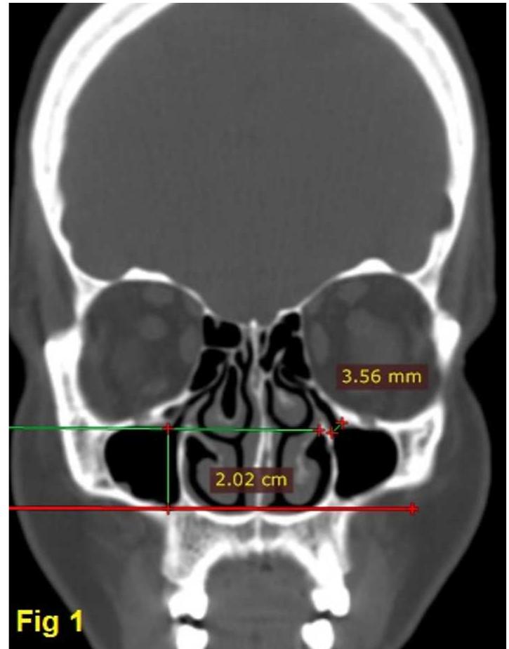 Ct Distance Ct dimensions of the maxillary sinus using axial and coronal