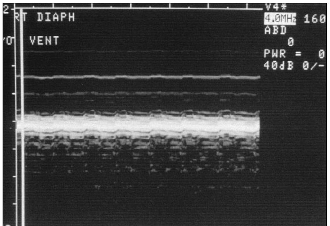 (PDF) Ultrasonographic evaluation of diaphragmatic motion